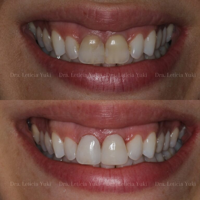 facetas dentárias