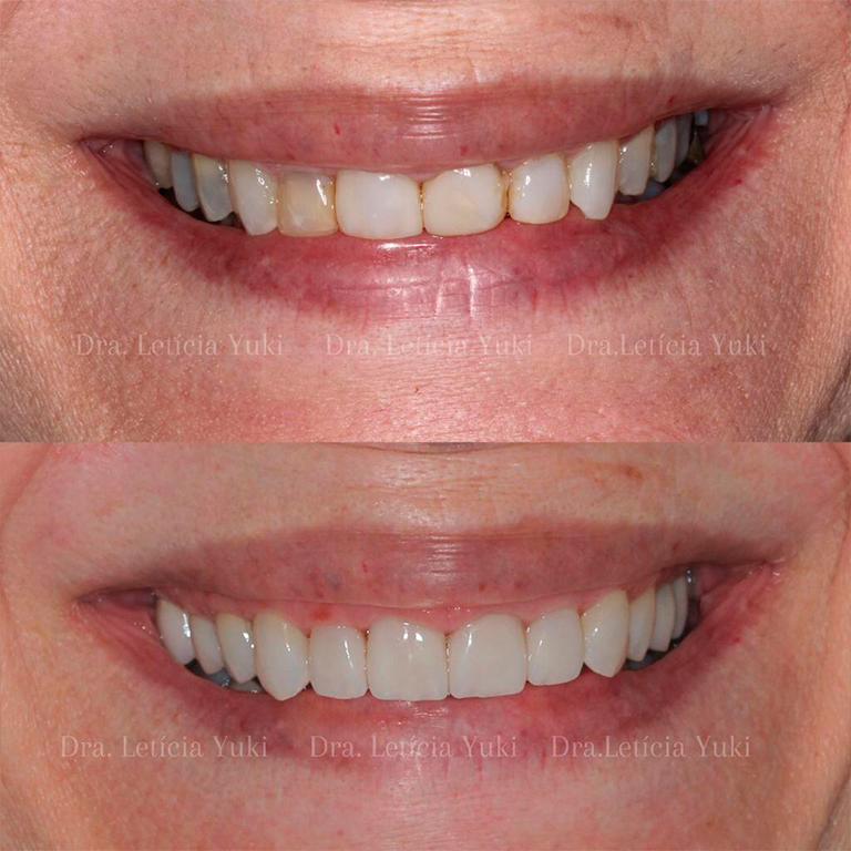 facetas dentárias
