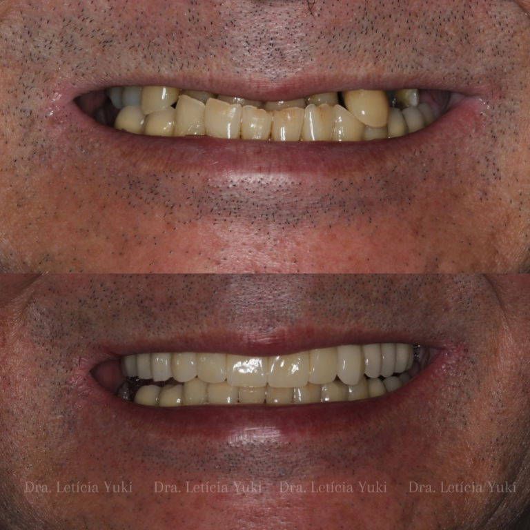 facetas dentárias