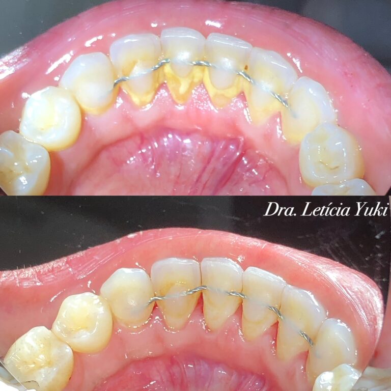 facetas dentárias