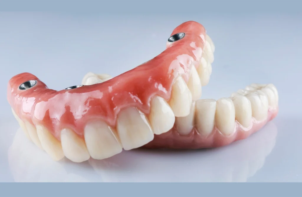 facetas dentárias
