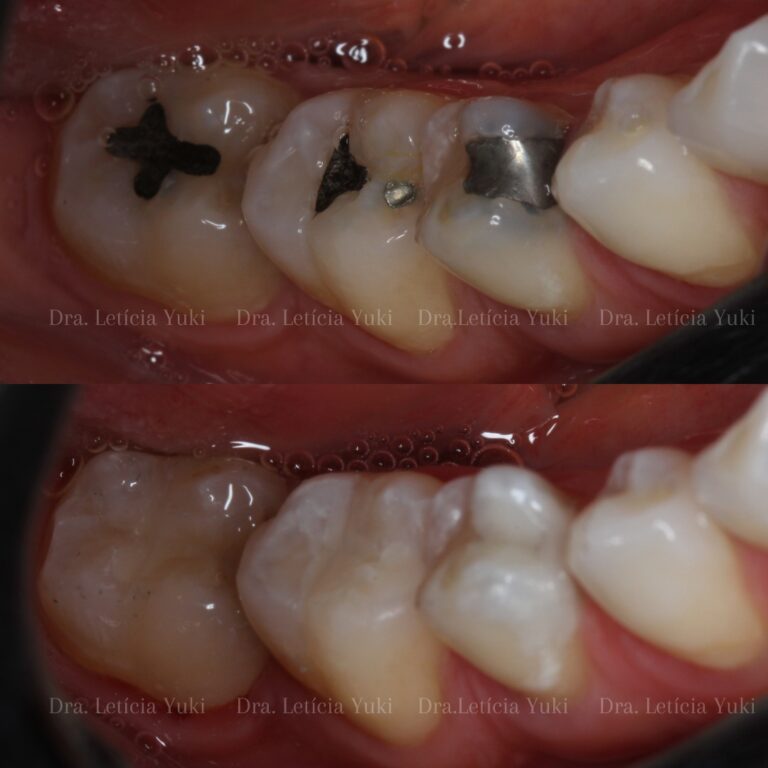 facetas dentárias