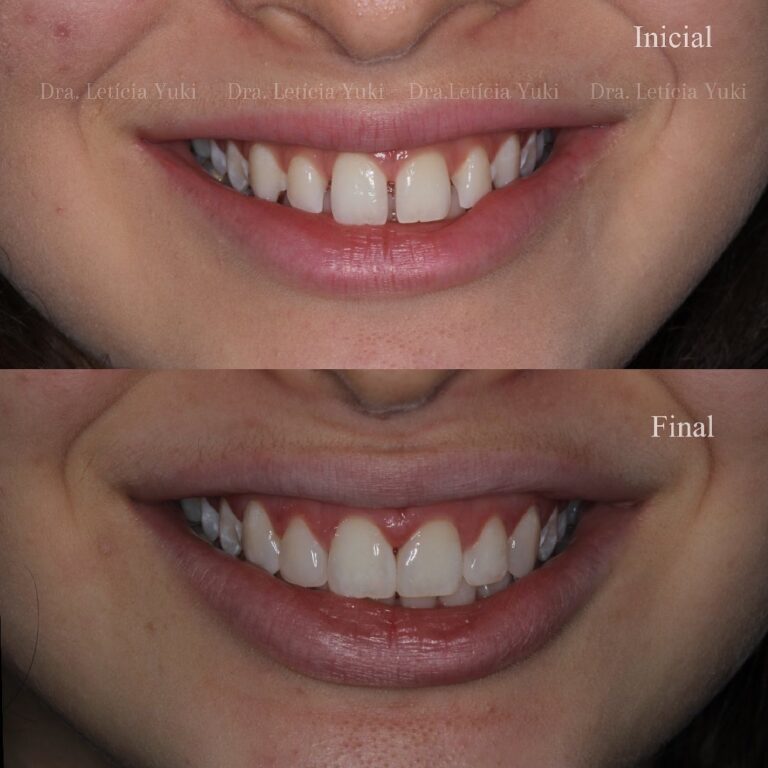 facetas dentárias