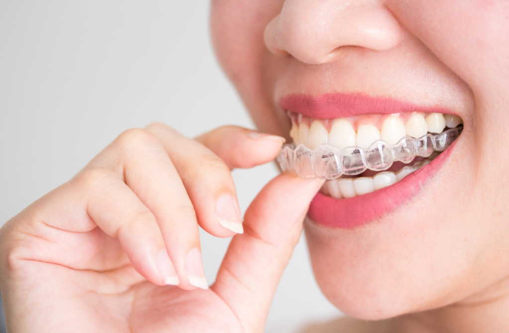 facetas dentárias