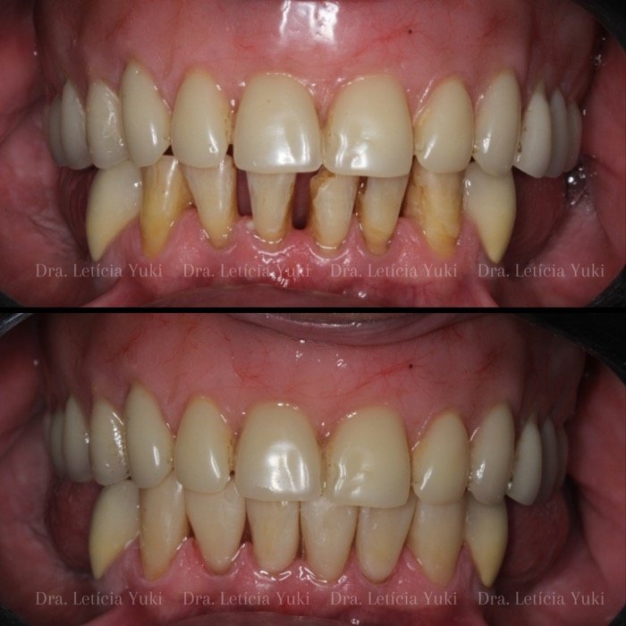 Caso 1: antes e depois