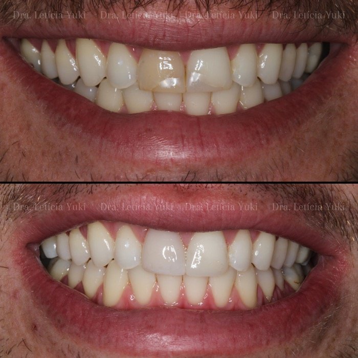 Caso 2: antes e depois