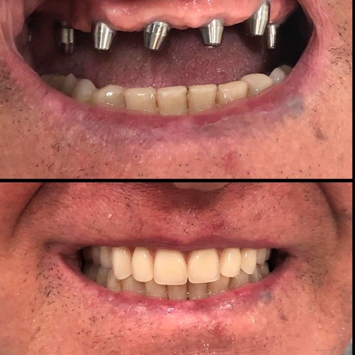 Caso 4: antes e depois