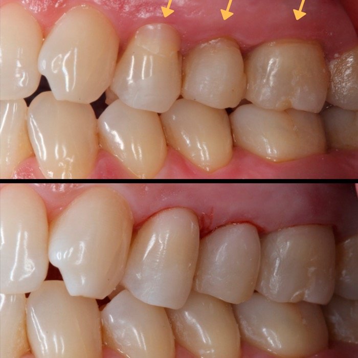 Caso 5: antes e depois