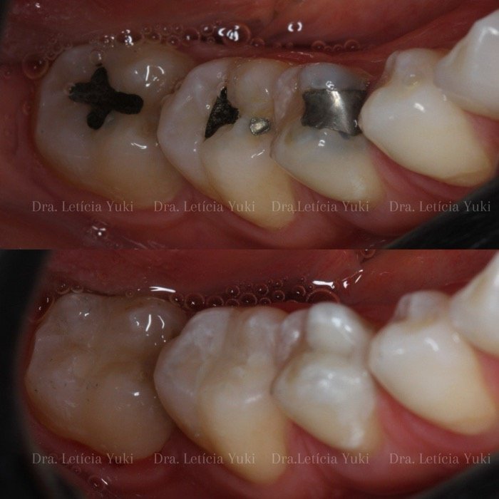 Caso 11: antes e depois
